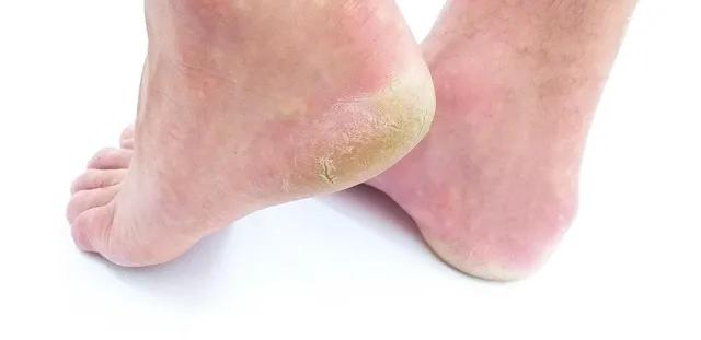 Heel Relief
